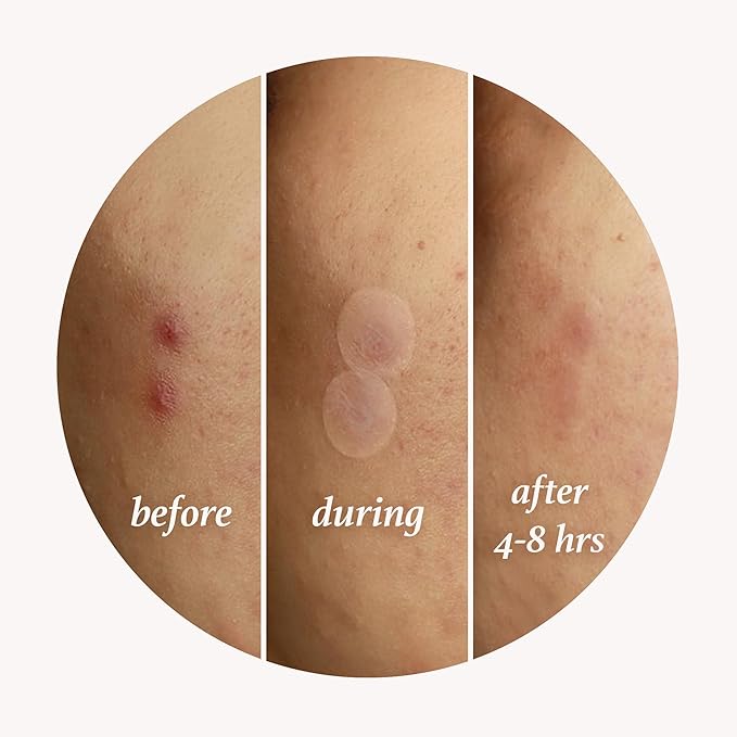 Julep Skin Perfecting Duo (2pc set) - Julep Patch Me Up Waterproof Pimple Patches 72 pcs & Cushion Complexion Concealer & Corrector Stick Infused with Turmeric & Hyaluronic Acid - Amber 400