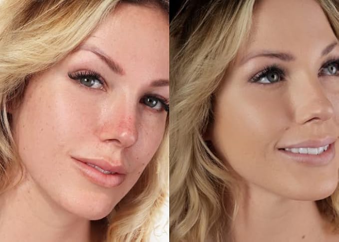 Loves-You-Back 3in1 Mineral Powder Foundation (BEIGE 1) | Designed for Rosacea, Acne-Prone, Sensitive Skin | 3IN1 Concealer, Powder + Foundation | Non-Caking, Non-Drying