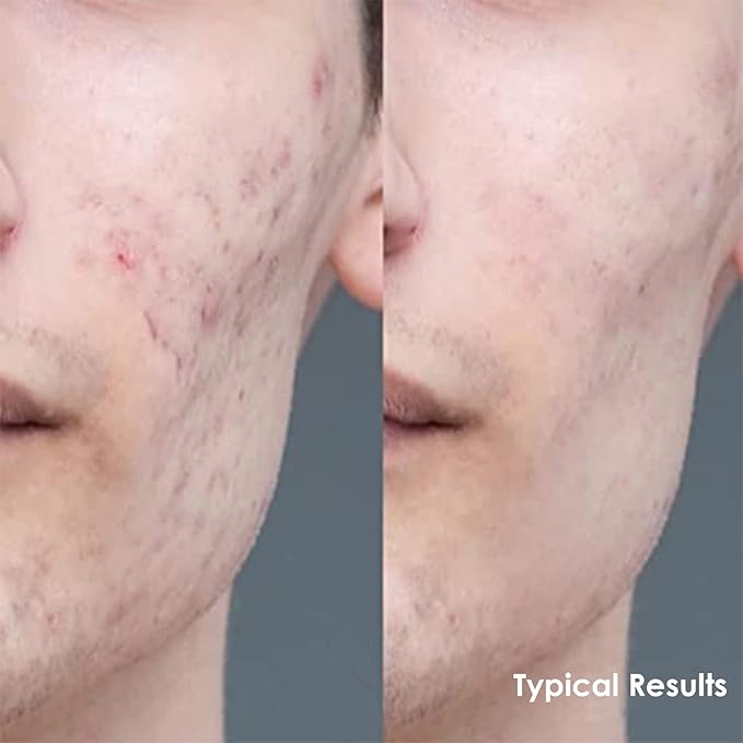 Tinted Moisturizer for Men by Apricus Skincare | Face Moisturizer Anti Aging and Anti-Redness | Dark Spot Concealer Cream and Redness Corrector | Matte Acne Face Moisturizer, 0.67 Oz, (Medium)