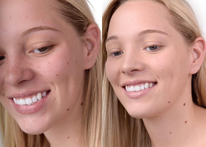 Loves-You-Back 3in1 Mineral Powder Foundation (BEIGE 1) | Designed for Rosacea, Acne-Prone, Sensitive Skin | 3IN1 Concealer, Powder + Foundation | Non-Caking, Non-Drying