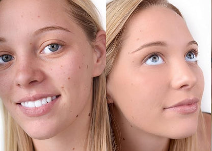 Loves-You-Back 3in1 Mineral Powder Foundation (BEIGE 1) | Designed for Rosacea, Acne-Prone, Sensitive Skin | 3IN1 Concealer, Powder + Foundation | Non-Caking, Non-Drying