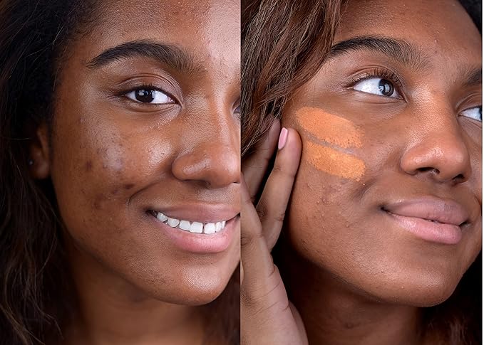 Loves-You-Back 3in1 Mineral Powder Foundation (CARAMEL 4) | Designed for Acne-Prone, Sensitive Skin | Hyperpigmentation | Covers Dark Circles | 3IN1 - Concealer, Foundation + Powder