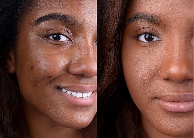 Loves-You-Back 3in1 Mineral Powder Foundation (CARAMEL 4) | Designed for Acne-Prone, Sensitive Skin | Hyperpigmentation | Covers Dark Circles | 3IN1 - Concealer, Foundation + Powder