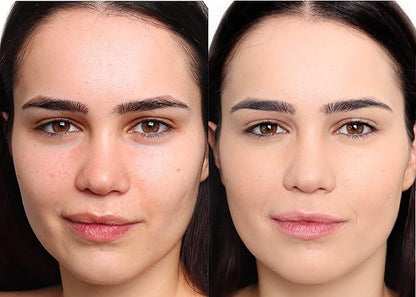 Loves-You-Back 3in1 Mineral Powder Foundation (BEIGE 2) | Designed for Rosacea, Acne-Prone, Sensitive Skin | 3IN1 - Concealer, Powder and Foundation | Natural + Lightweight Coverage